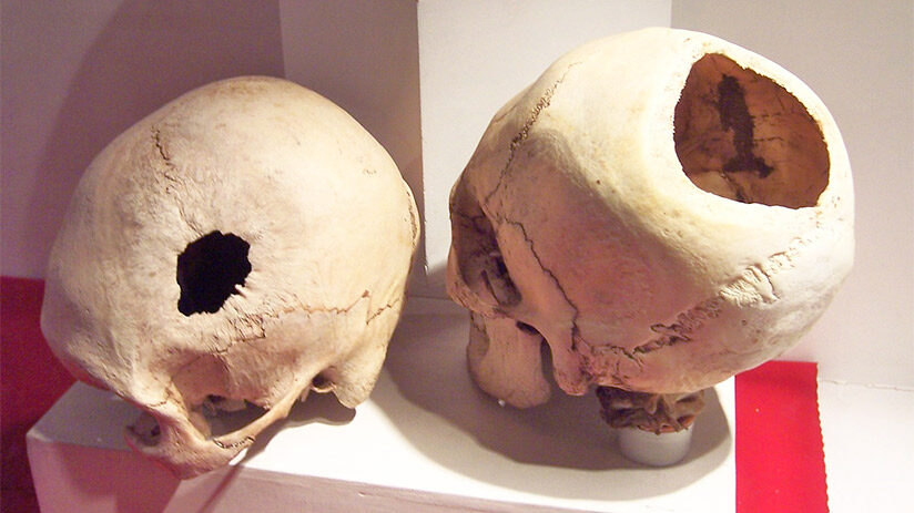 facts about the incas cranial trepanations