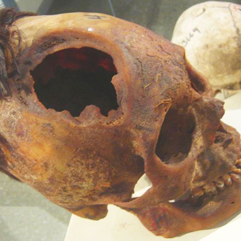 Skull Trepanation